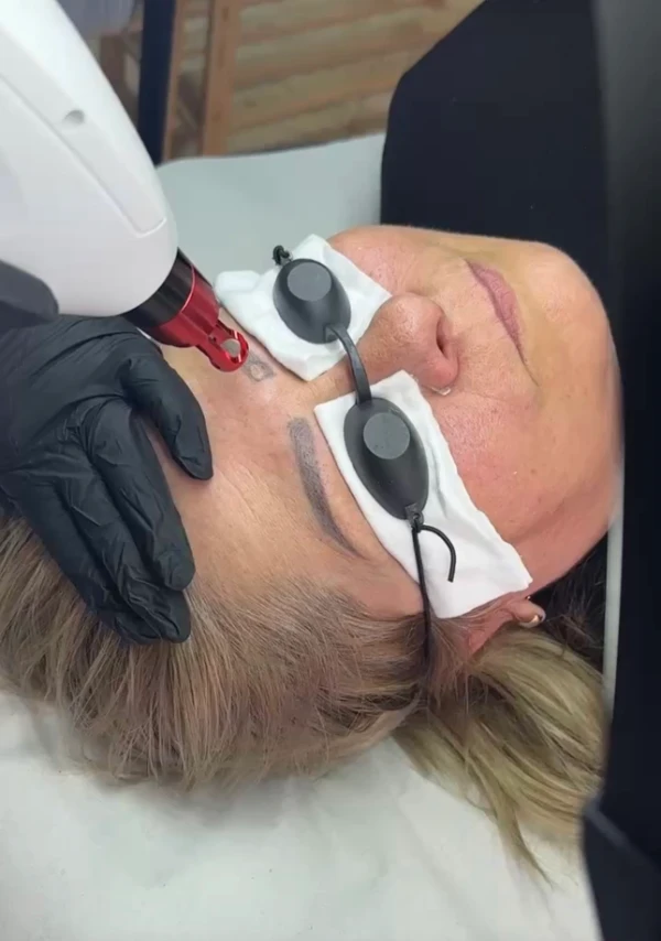 Remoção a Laser — JT Studio Setúbal